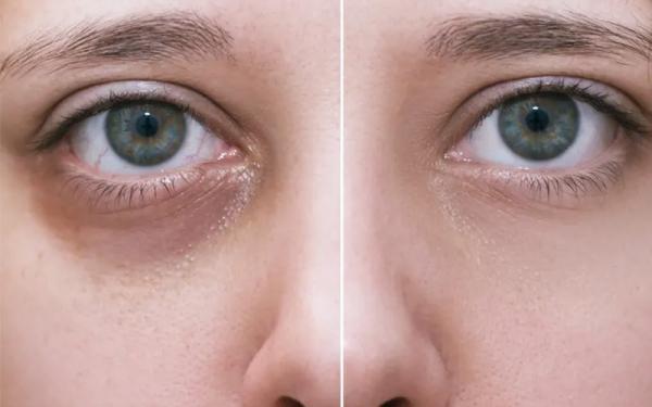 گودی زیر چشم؛ اثری از سن که با تزریق فیلر رفع می گردد گودی زیر چشم؛ اثری از سن که با تزریق فیلر رفع می گردد